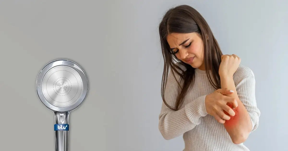 Woman scratching irritated skin, blu Ionic Shower Filter handheld alongside